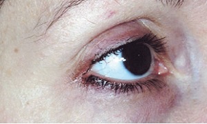 Vzhled očního okolí po 8-týdenním použití REGU-AGE PF