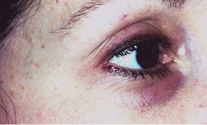 Vzhled očního okolí před použitím REGU-AGE PF